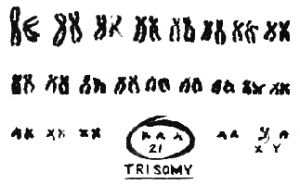 trisomy