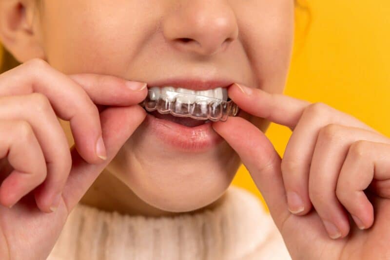 teeth aligner