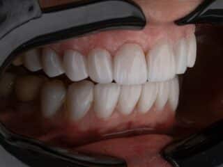 How to Clean New Dentures: Daily Steps + Travel-Friendly Tips a person's mouth with teeth
